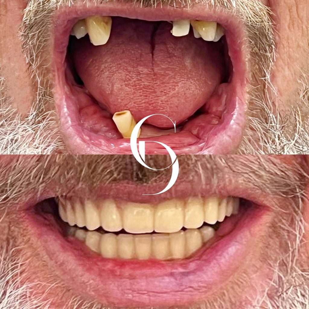 All-on-4 Implants