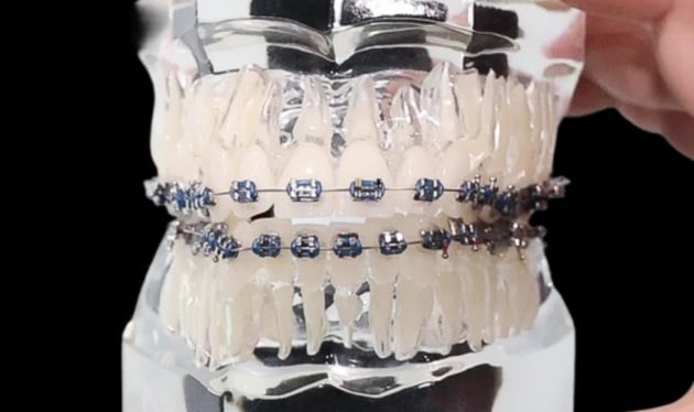 Dental Braces