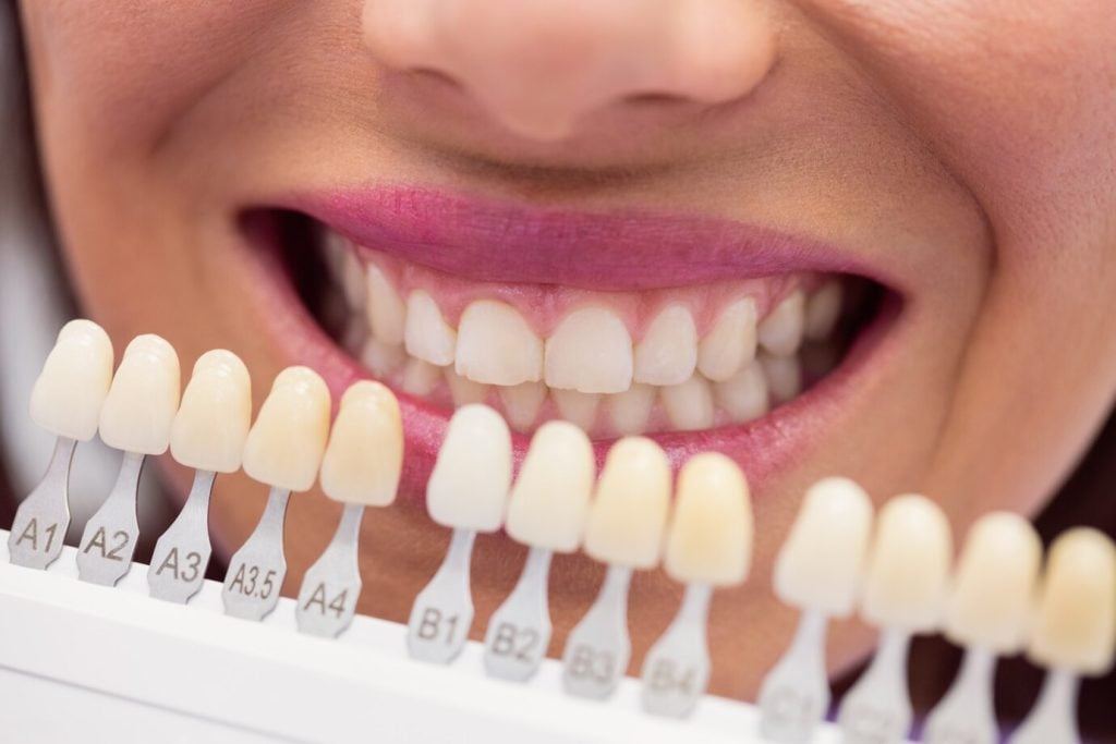A Guide to Effective Maintenance and Prolonged Longevity of Veneers for Your Smile Transformation