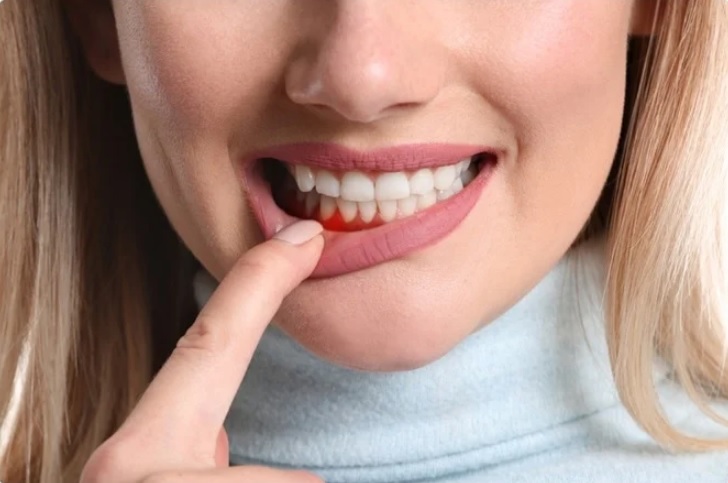 Bleeding Gums