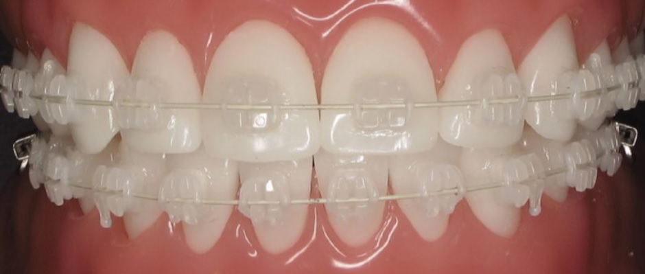Ceramic Braces