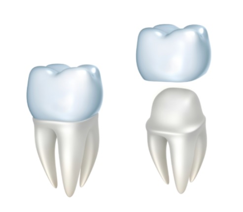 Dental Crown Sydney