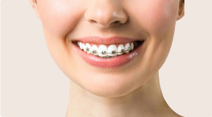 Different Types of Braces