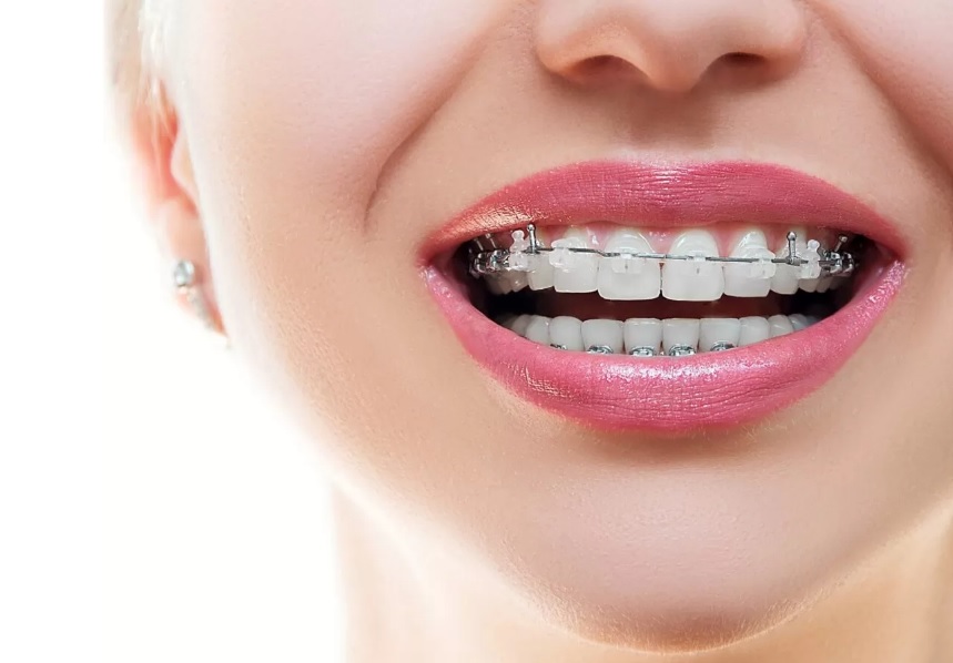 How Much Are Braces?