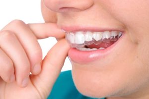 Invisalign For Underbite