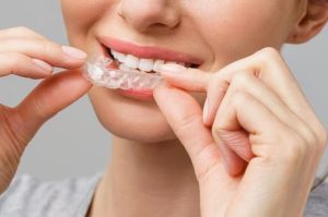 Invisalign Is It worth It?