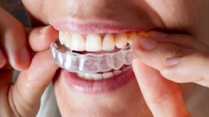 Invisalign Jaw Alignment