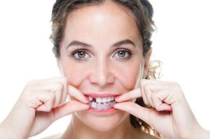 Invisalign With Missing Teeth