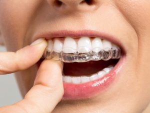 Invisalign for Overbite