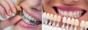 Invisalign or Veneers