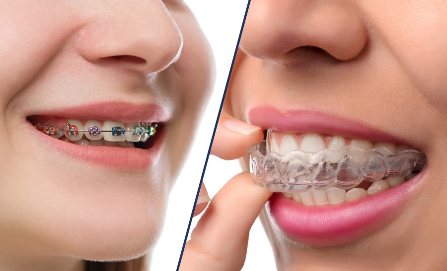 Invisalign versus Braces