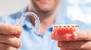 Invisalign vs Braces Cost