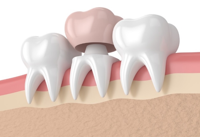Is A Dental Crown Necessary?