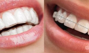 Is Invisalign Better Than Braces?
