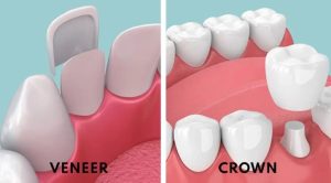 Porcelain Crowns Vs Porcelain Veneers