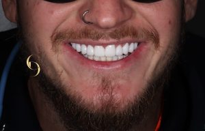 Porcelain Veneers Before and After