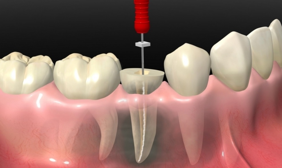 Root Canal Treatment Guide