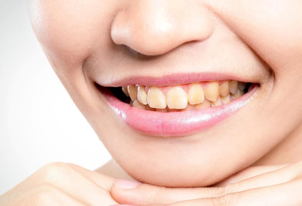 Symptoms & Side Effects of Teeth Grinding: How to Stop Teeth Grinding
