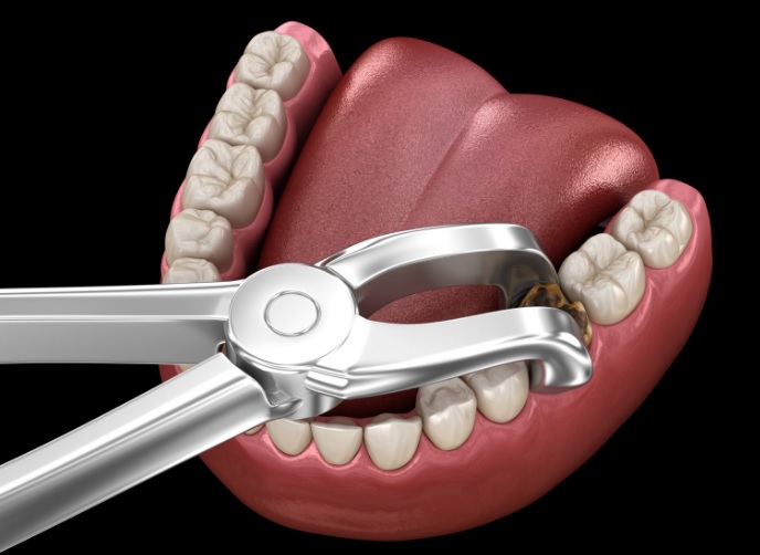 Tooth Extraction Cost