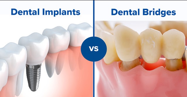 Tooth Replacement