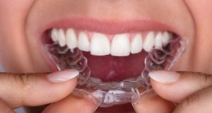 What Is Invisalign?