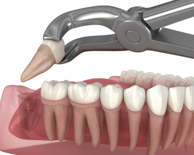 Wisdom Teeth Removal Cost