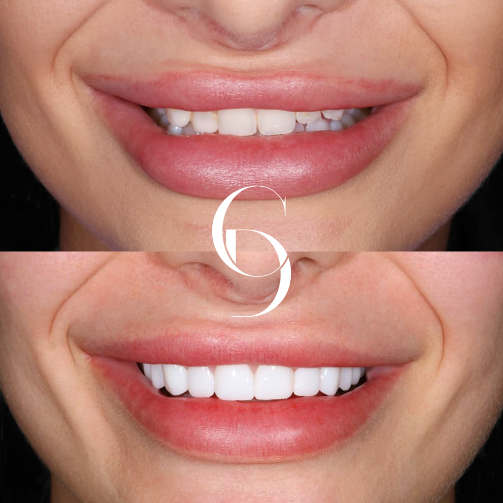 Addison's Veneers Makeover In Cosmetique Dental™