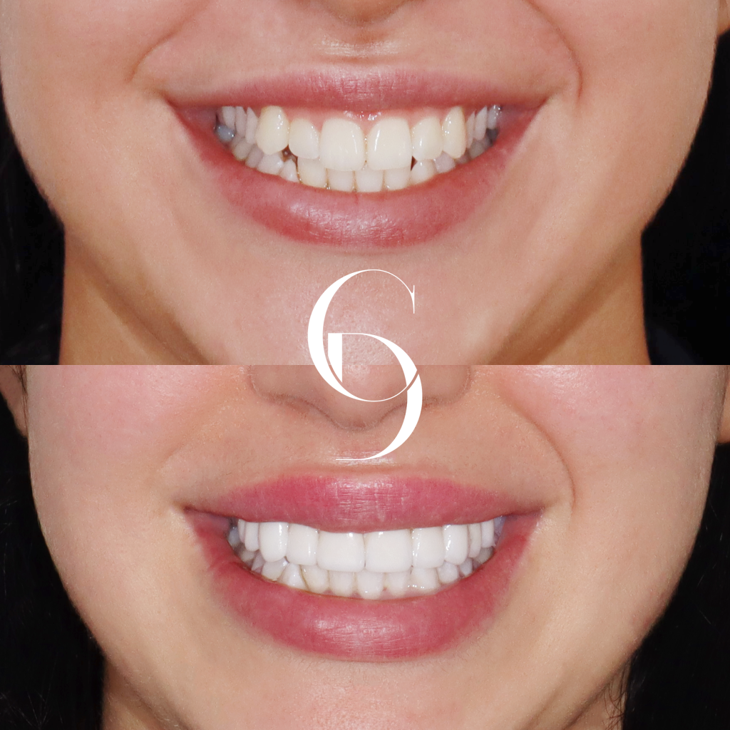 Alexis's Porcelain Veneers A Clinical Case Study In Sydney CBD
