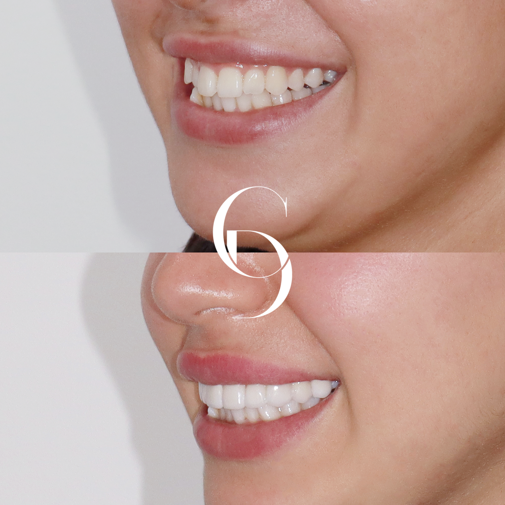 Alexis's Porcelain Veneers A Clinical Case Study In Sydney CBD