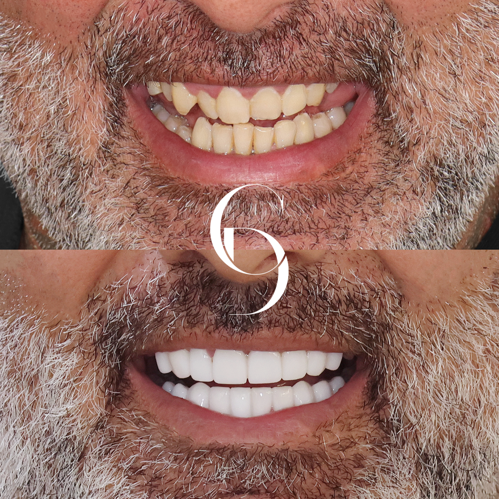 Alfie's Veneers Makeover In Cosmetique Dental™