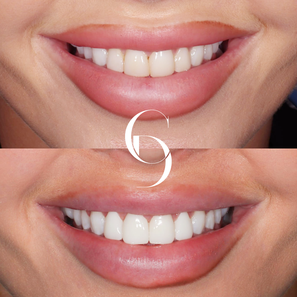 Alice's Veneers Makeover In Cosmetique Dental™