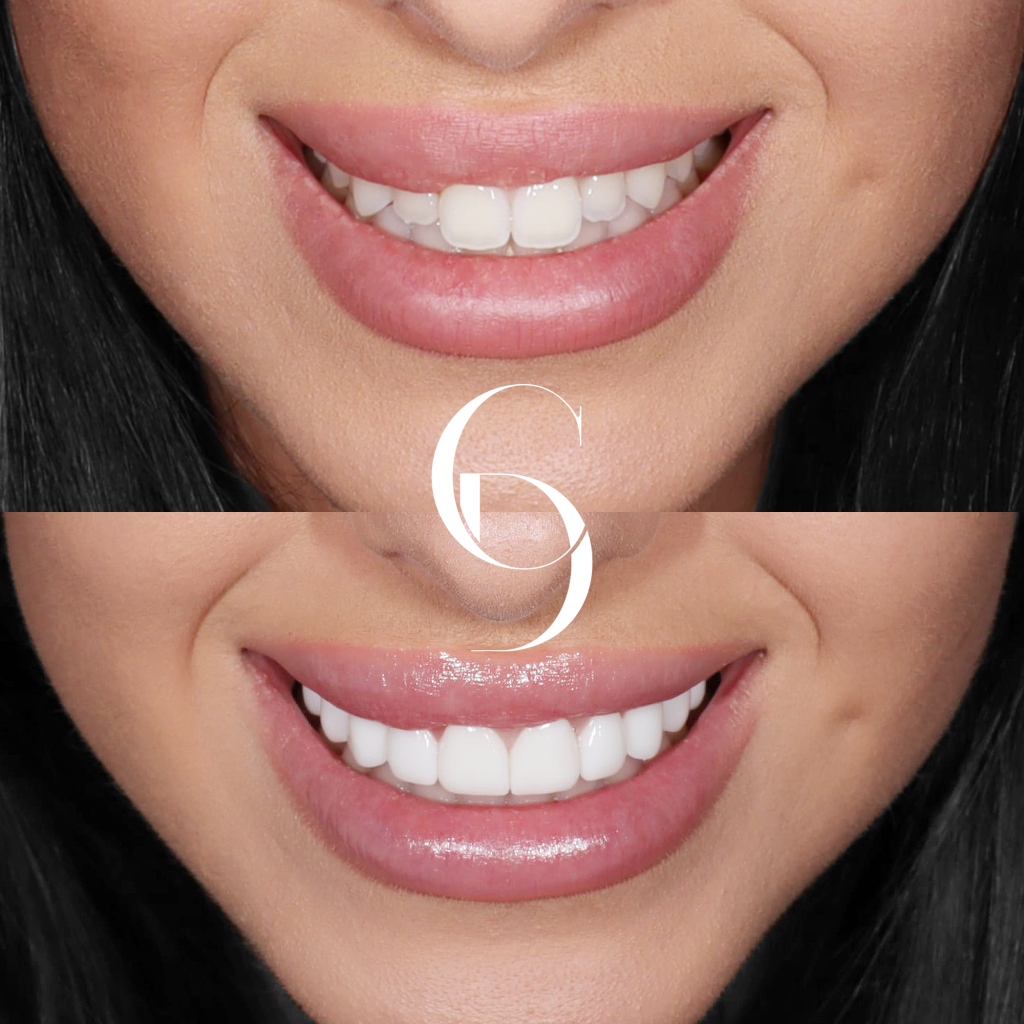 Amelia Veneers Makeover In Cosmetique Dental™ Amelia's Veneers Makeover In Cosmetique Dental™