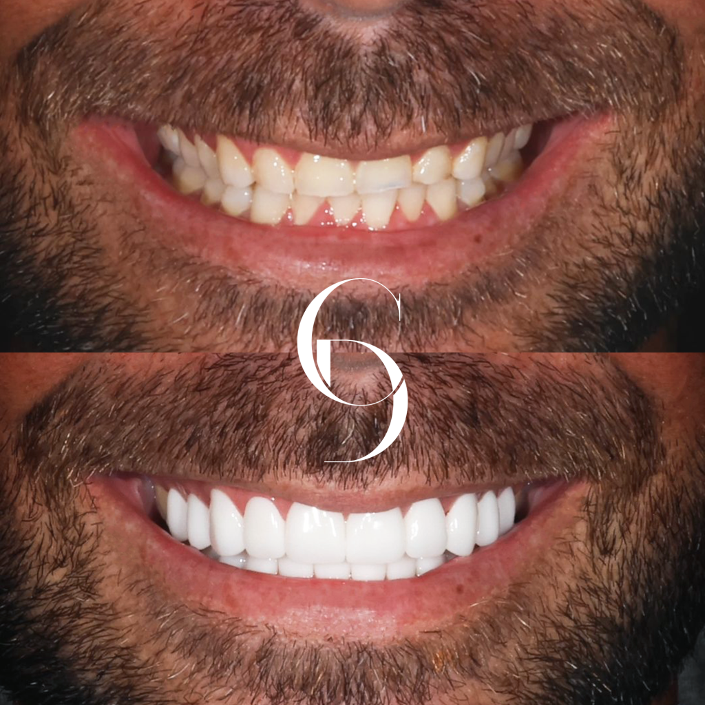 Angus' Veneers Makeover In Cosmetique Dental™