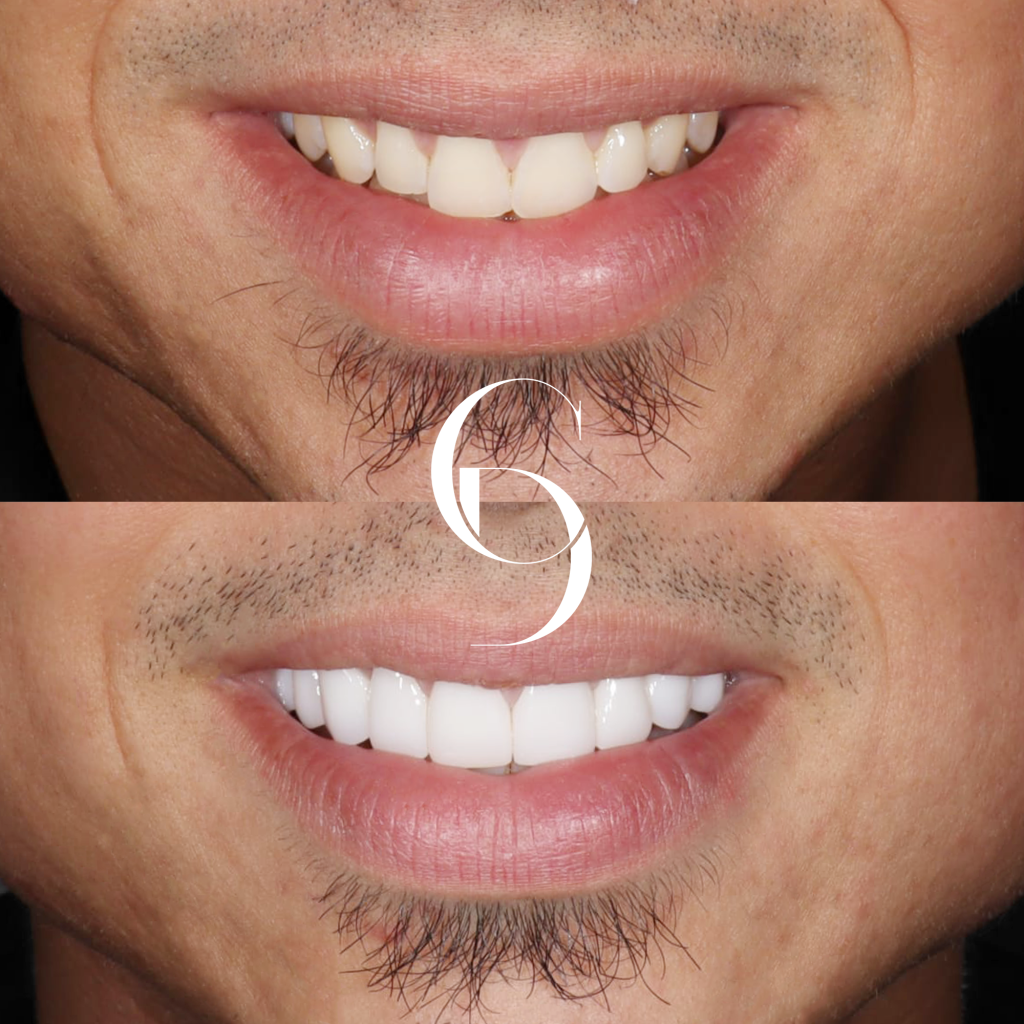 Archie's Veneers Makeover In Cosmetique Dental™