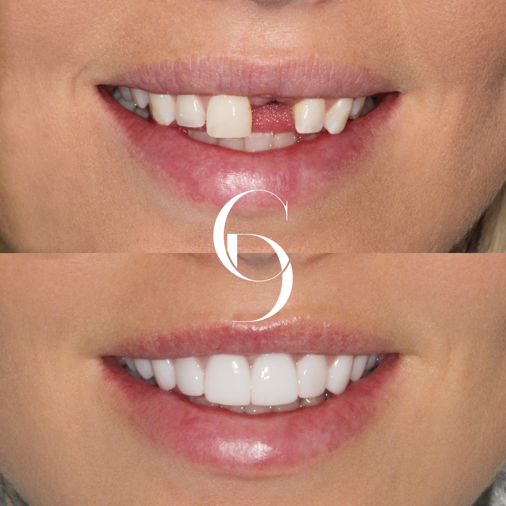Aria's Implant Makeover In Cosmetique Dental™
