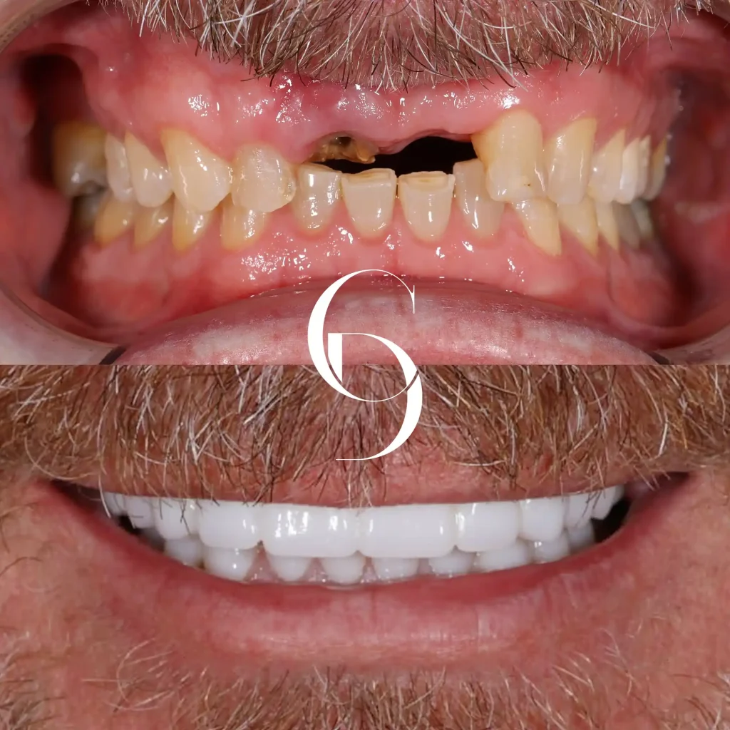 Arthur's Dental Implants In Cosmetique Dental™