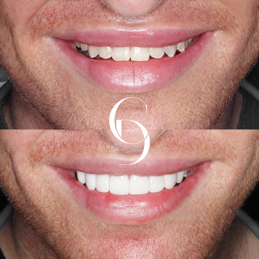 Ashton's Veneers Makeover In Cosmetique Dental™
