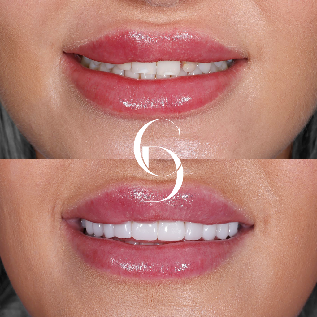 Ava's Veneers Makeover In Cosmetique Dental™