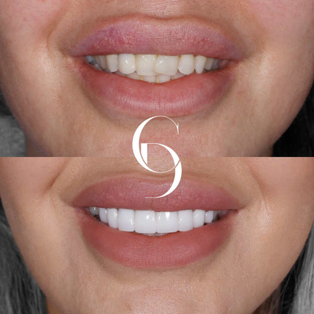 Ayla's Veneers Makeover In Cosmetique Dental™