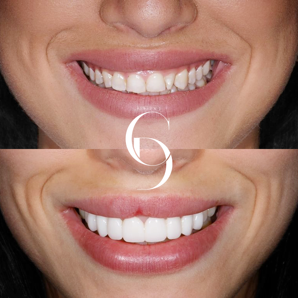 Bella's Veneers Makeover In Cosmetique Dental™