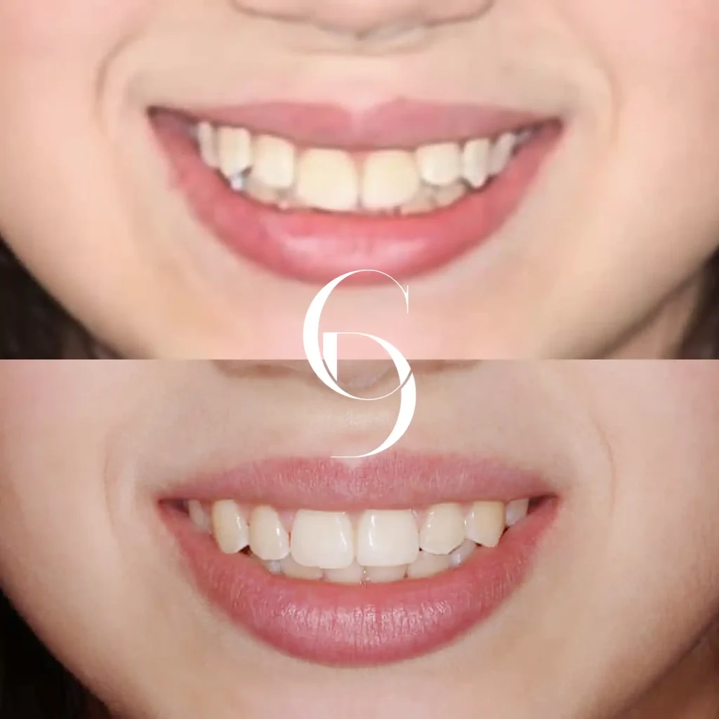 Bia’s Orthodontics Makeover In Cosmetique Dental™ Bia's Orthodontics Makeover In Cosmetique Dental™
