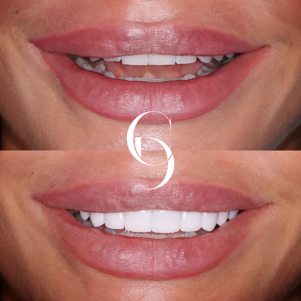 Billie's Veneers Makeover In Cosmetique Dental™