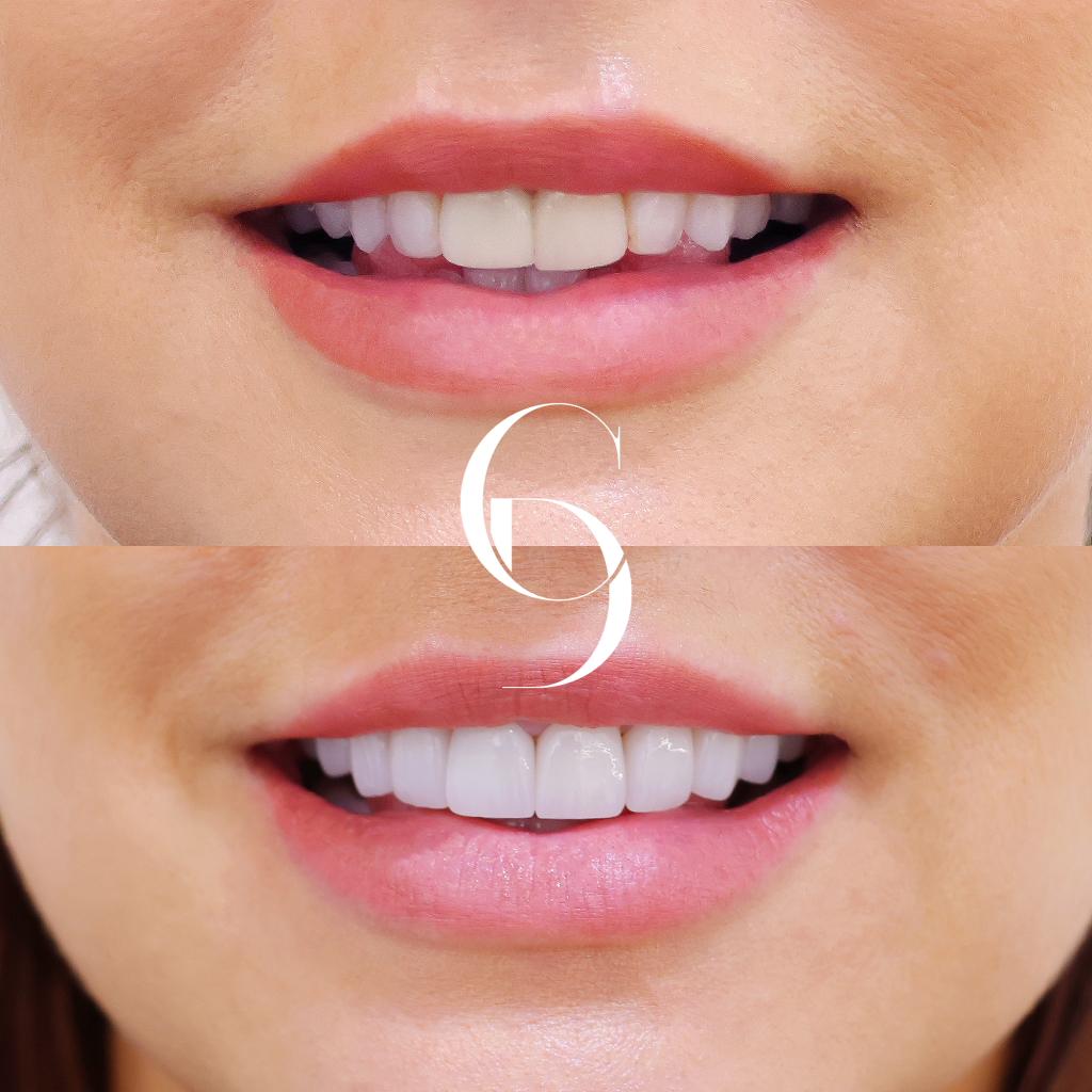 Bonnie's Veneers Makeover In Cosmetique Dental™