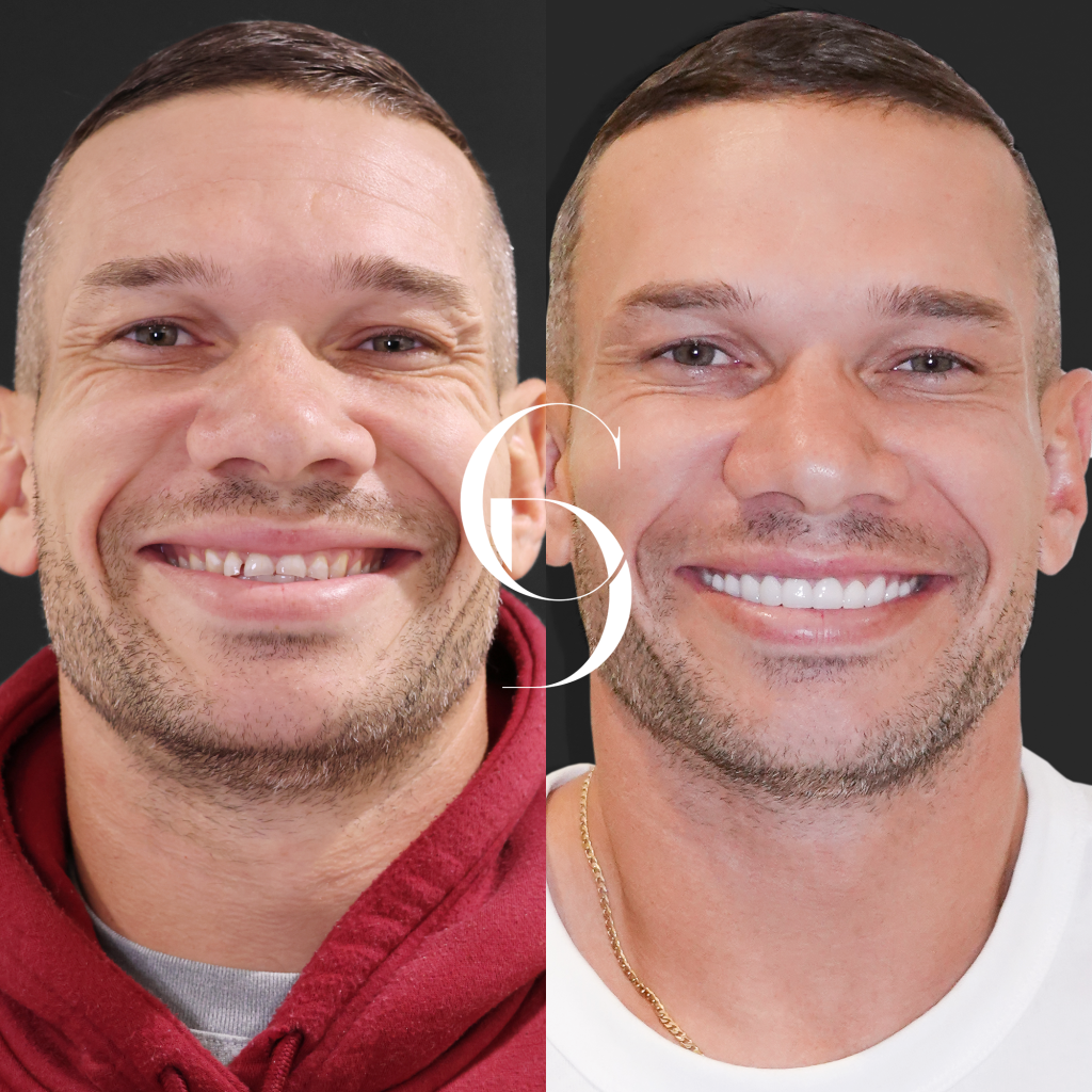 Brent's Porcelain Veneers A Clinical Case Study In Bondi Junction