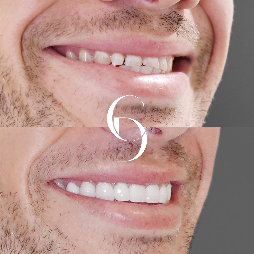 Brent's Porcelain Veneers A Clinical Case Study In Bondi Junction