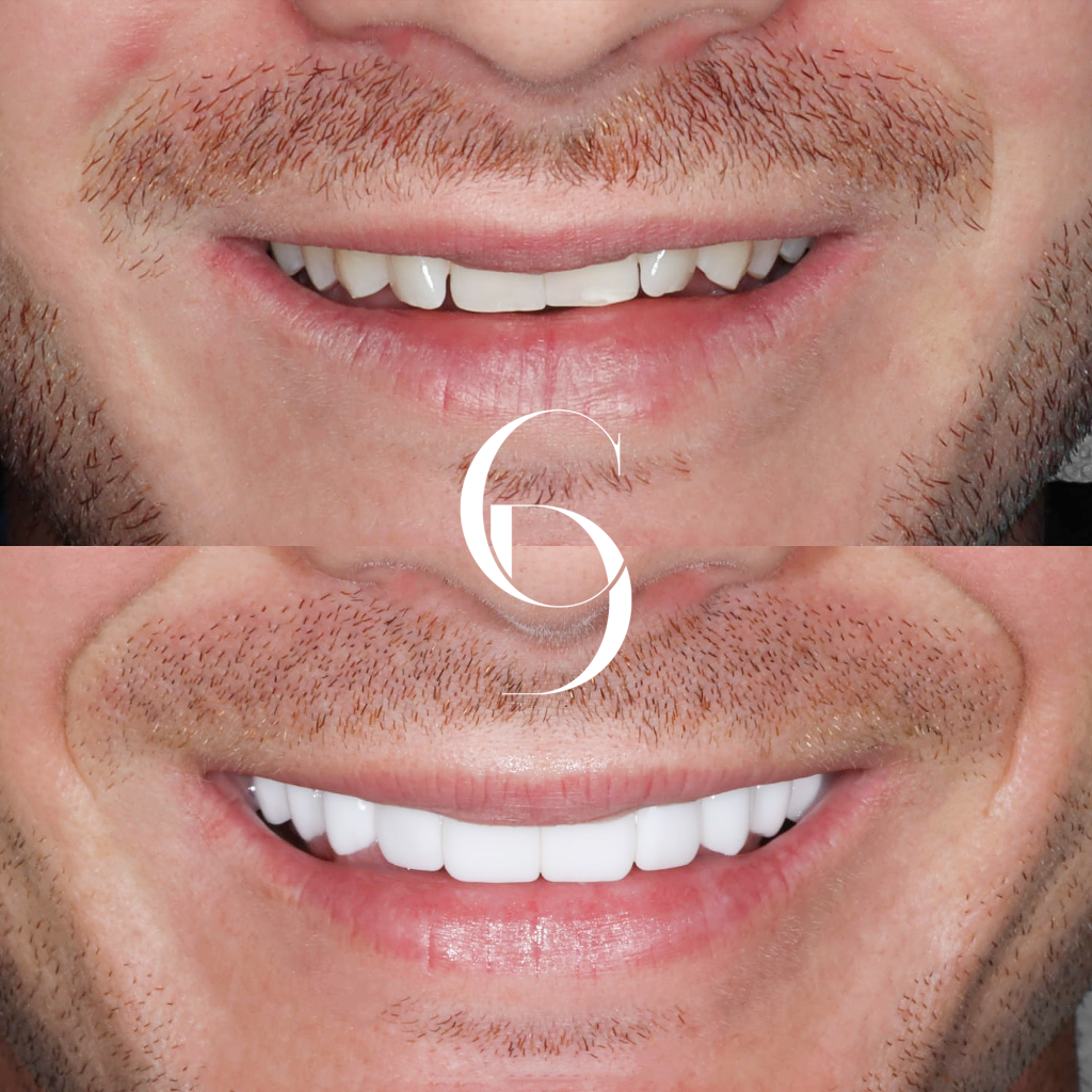 Bryce's Veneers Makeover In Cosmetique Dental™
