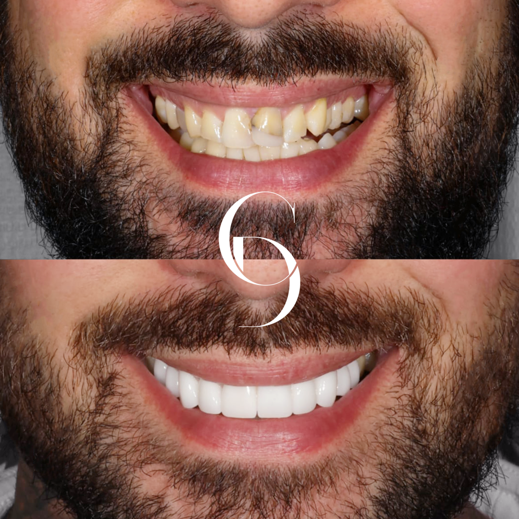 Byron's Veneers Makeover In Cosmetique Dental™