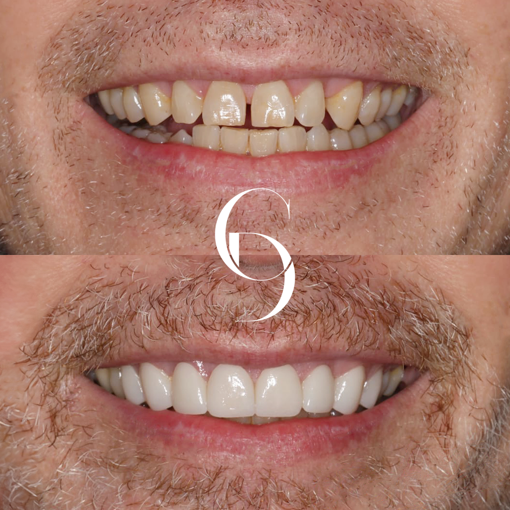 Charlie's Veneers Makeover In Cosmetique Dental™