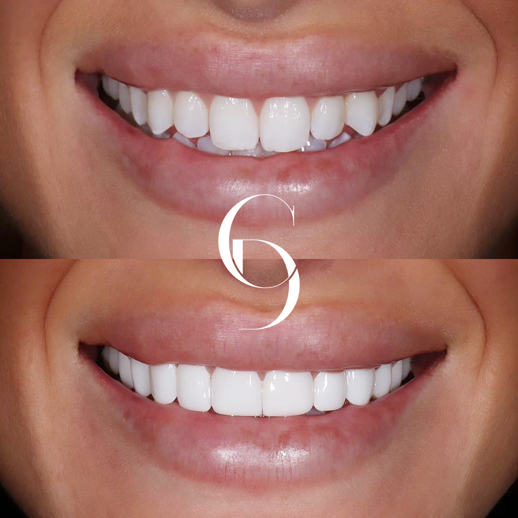 Charlotte Veneers Makeover In Cosmetique Dental™ Charlotte's Veneers Makeover In Cosmetique Dental™