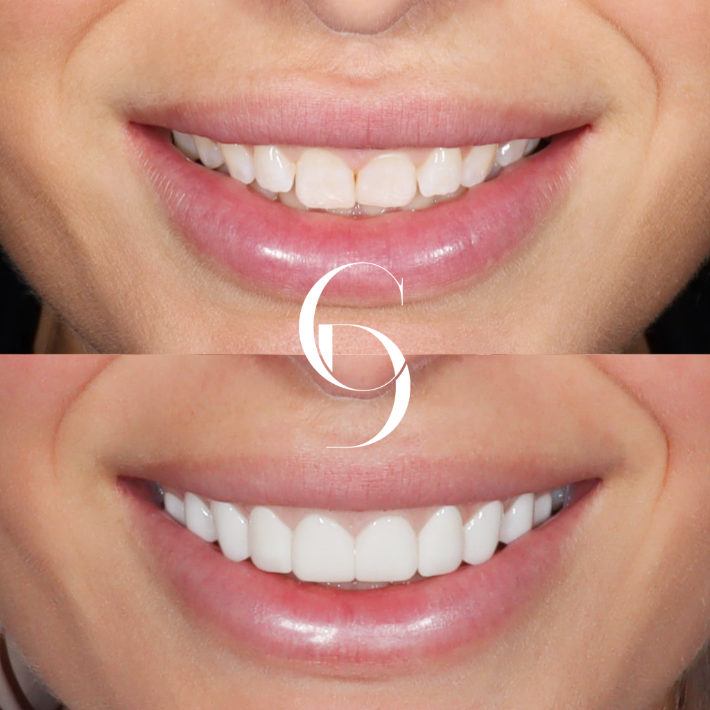 Chloe's Veneers Makeover In Cosmetique Dental™